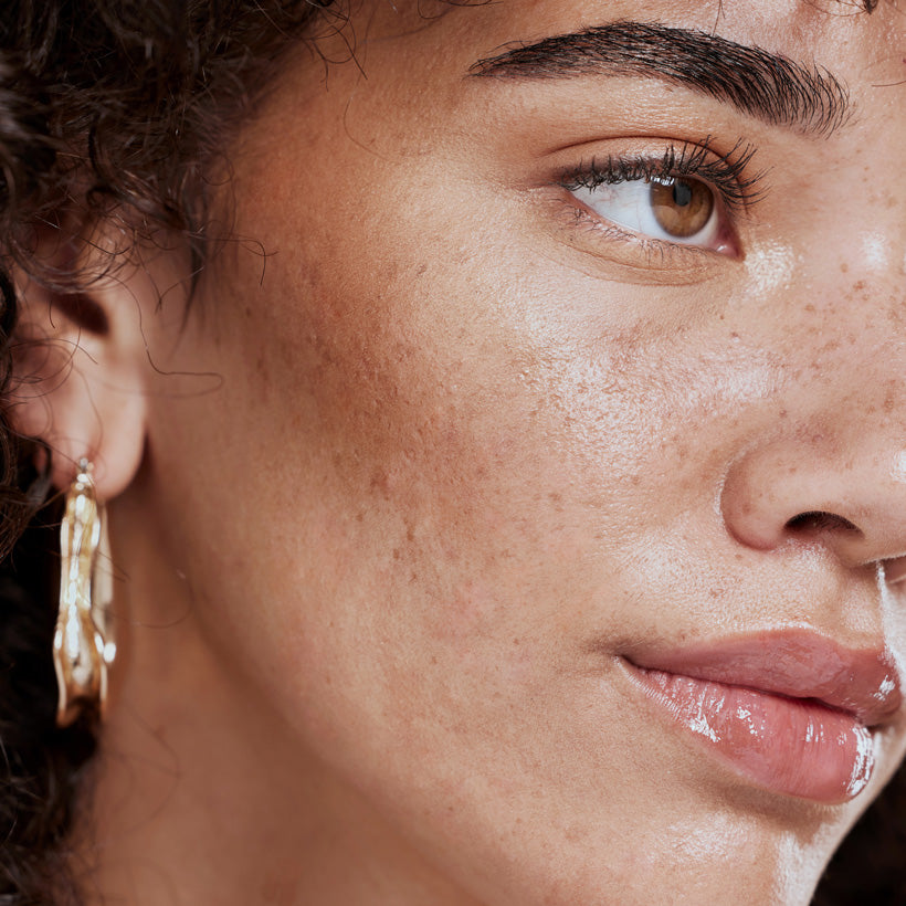 Transforming Oily Skin,  With Lipid-Based Skincare