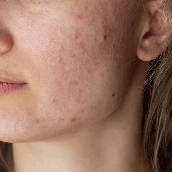 Picture of a woman with acne skin