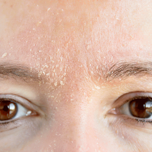 PF Image of flakey skin