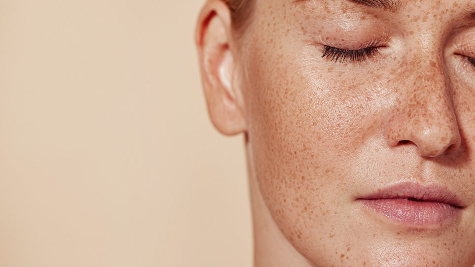 Woman_Freckles_LEITIN_Skincare